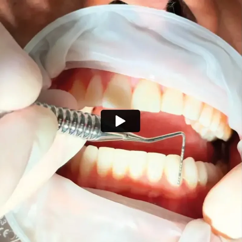 Primo piano di una visita odontoiatrica con strumenti dentali durante la valutazione per faccette dentali.