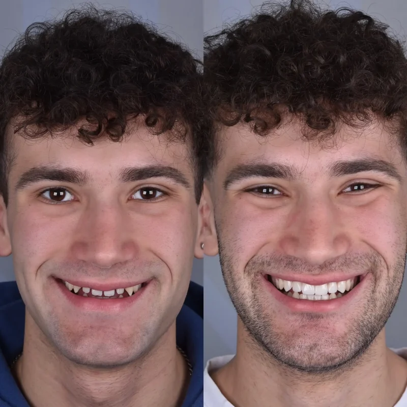 prima-e-dopo-andrea-3