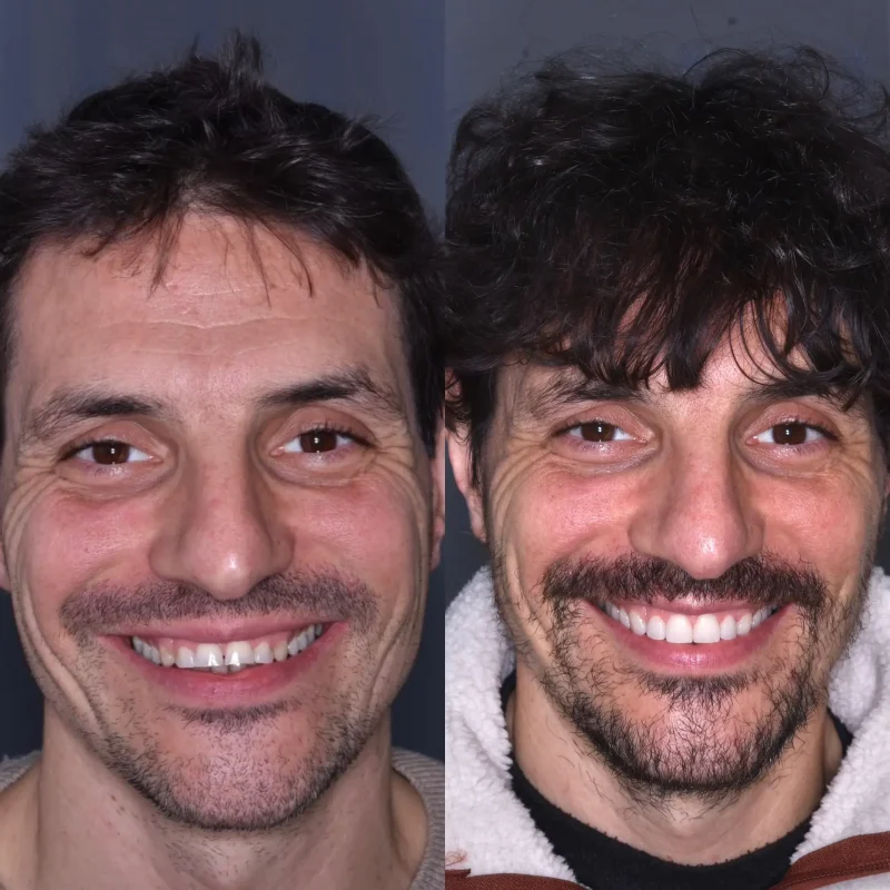 prima-e-dopo-lorenzo-4