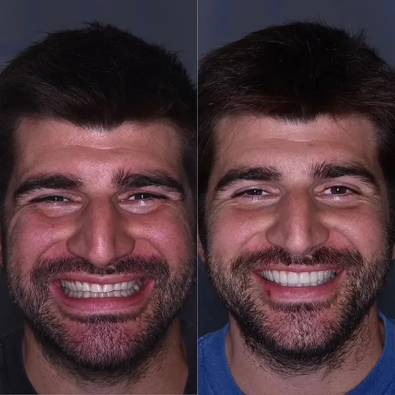 prima-e-dopo-stefano-faccette