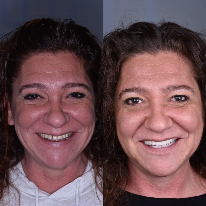 thumbnail-prima-e-dopo-lorena